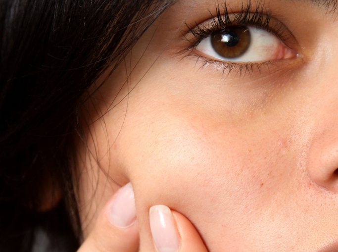 La biotina causa l'acne?  Guida per usarlo in sicurezza